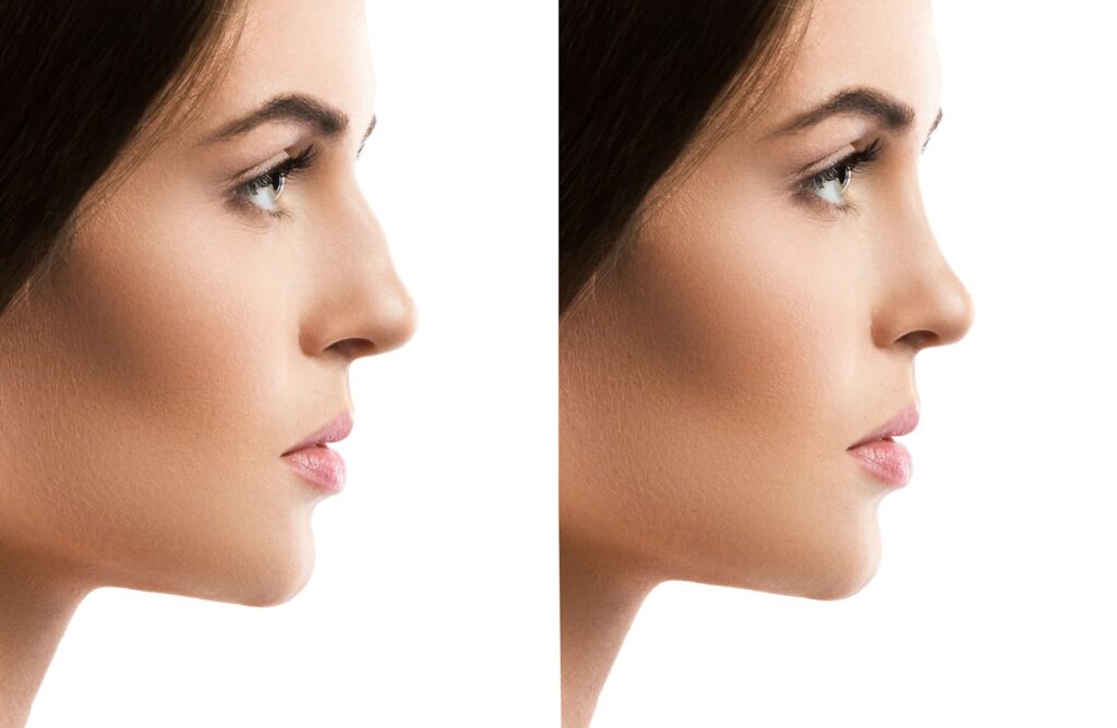 Rhinoplastie bosse du nez