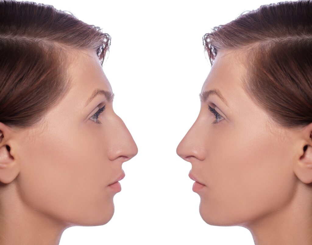 rhinoplastie pour supprimer une bosse