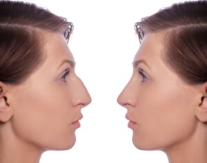 rhinoplastie pour supprimer une bosse