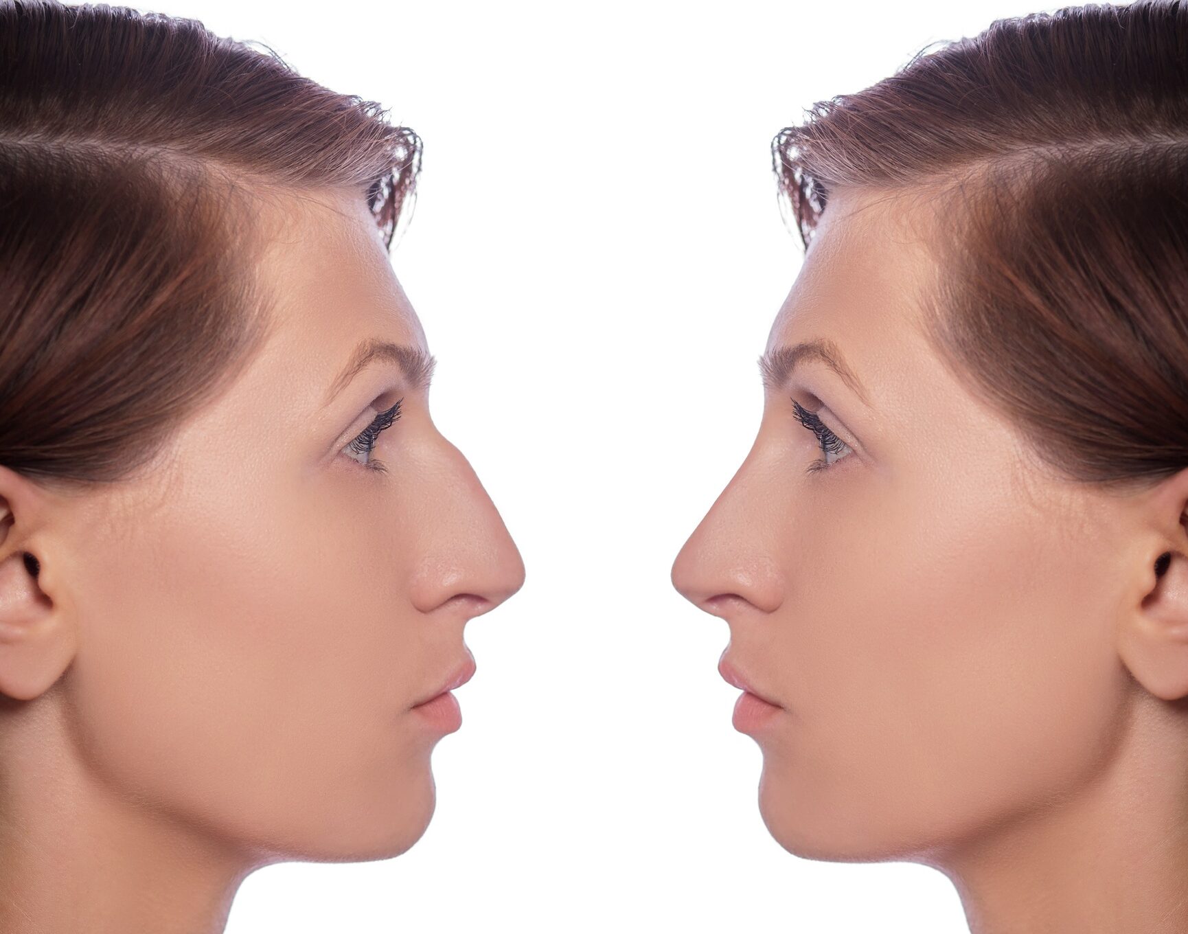 rhinoplastie pour supprimer une bosse