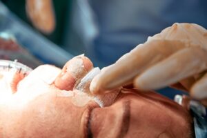 Rhinoplastie de préservation : conserver la dorsale