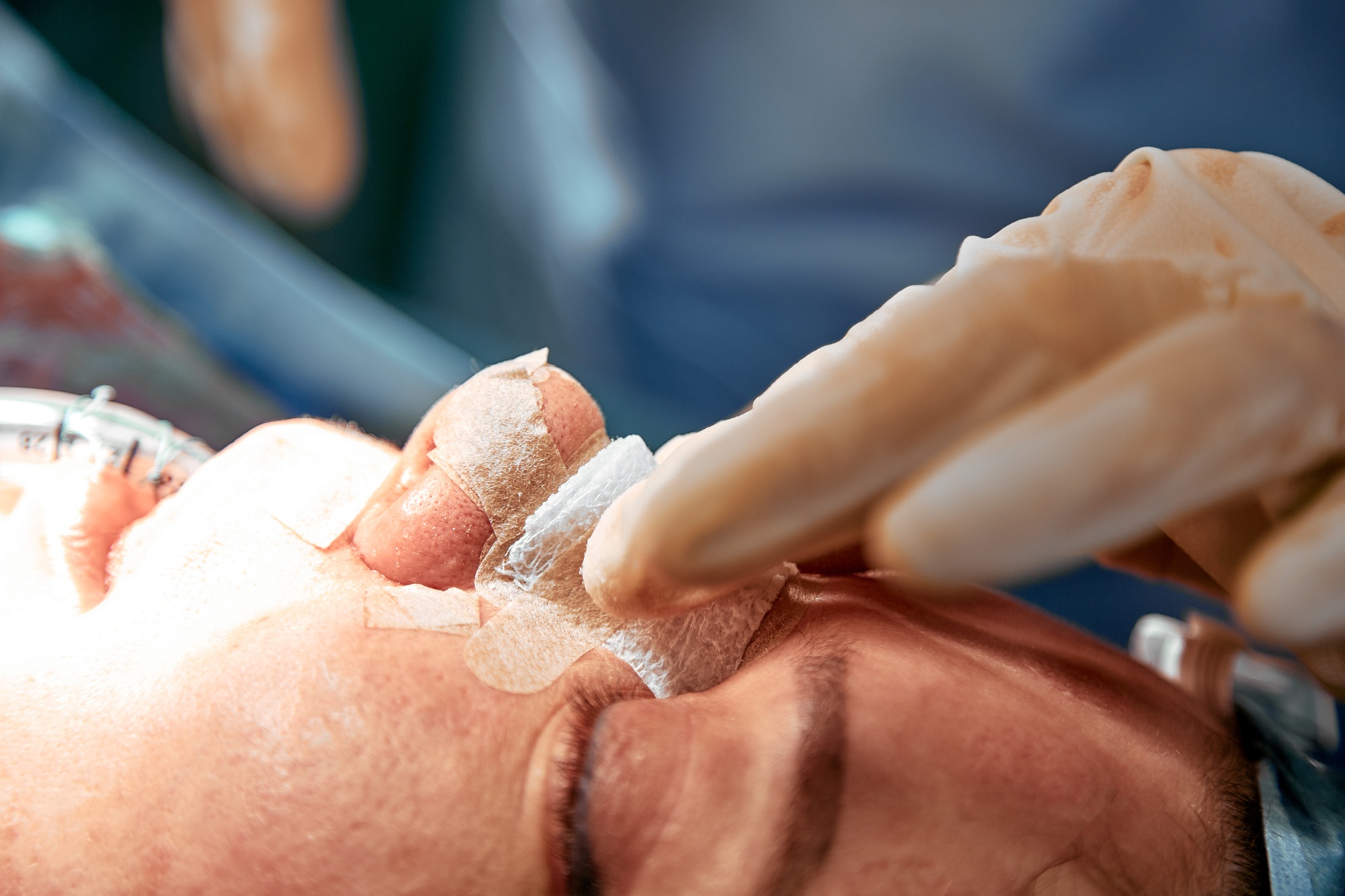 Rhinoplastie de préservation : conserver la dorsale