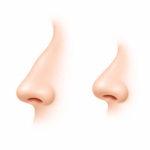 Rhinoplastie Nez Long nez bref