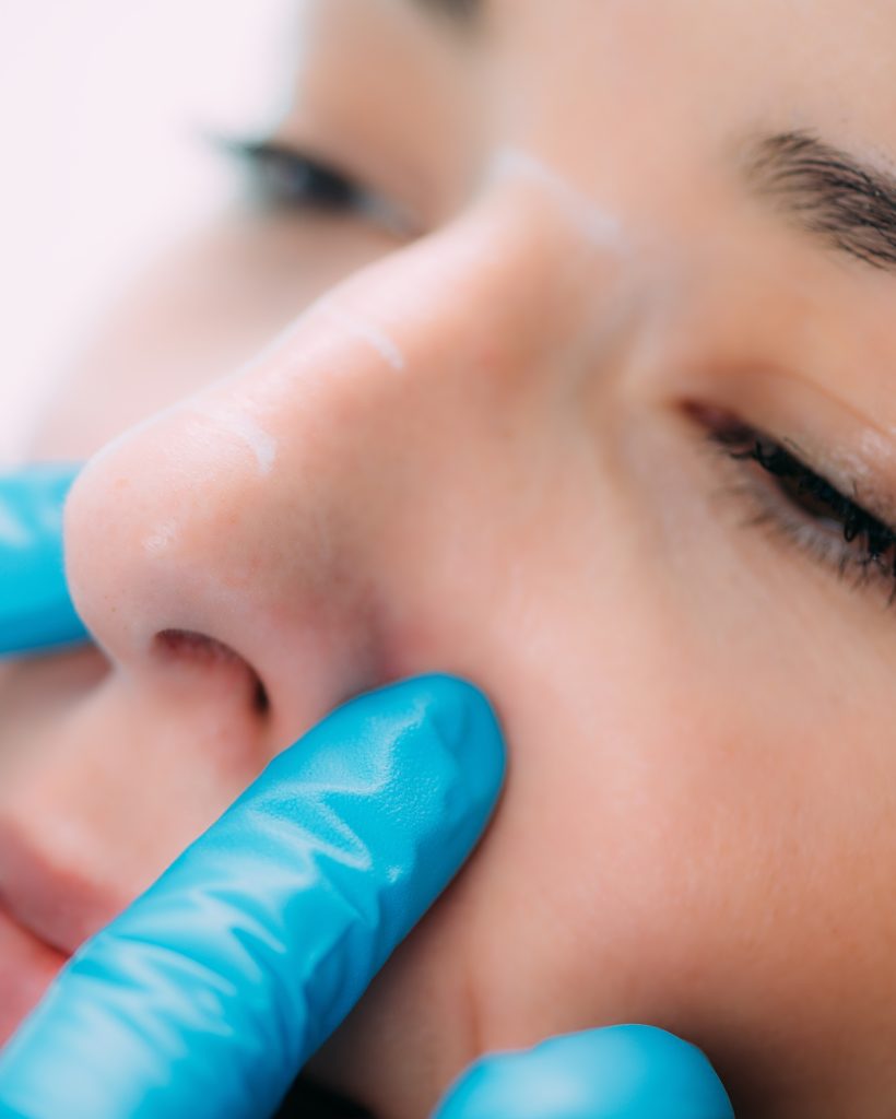 FAQ rhinoplastie lyon